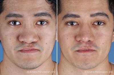 Cleft Lip Rhinoplasty Before & After Photos | Andre Panossian, M.D.