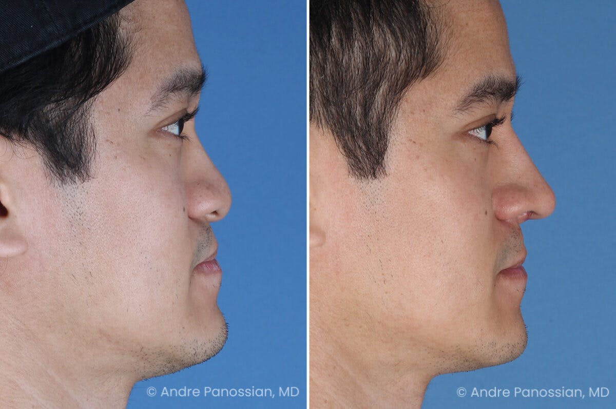 Cleft Lip Rhinoplasty Before & After Gallery - Patient 266817 - Image 1