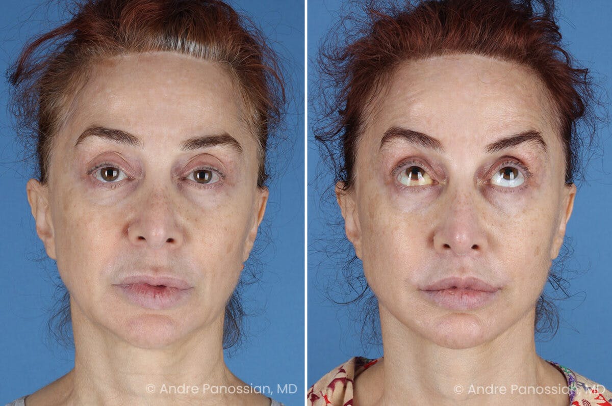 Facelift & Neck Lift Before & After Gallery - Patient 188334 - Image 1