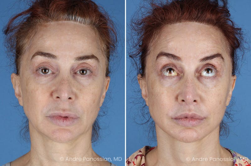 Facelift & Neck Lift Before & After Gallery - Patient 188334 - Image 1