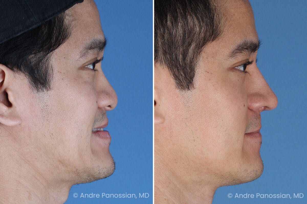 Cleft Lip Rhinoplasty Before & After Gallery - Patient 266817 - Image 3