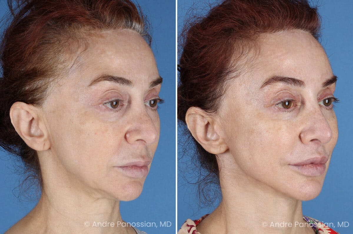 Facelift & Neck Lift Before & After Gallery - Patient 188334 - Image 2