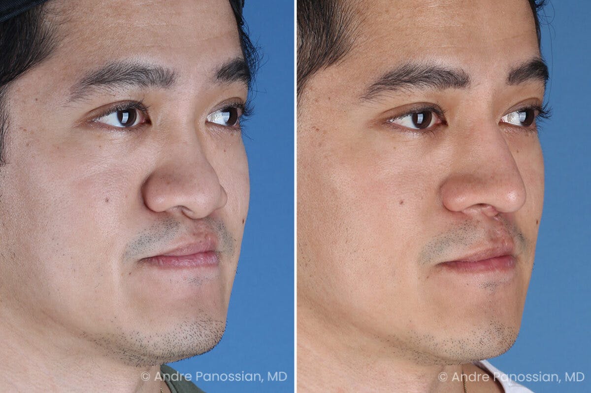 Cleft Lip Rhinoplasty Before & After Gallery - Patient 266817 - Image 4