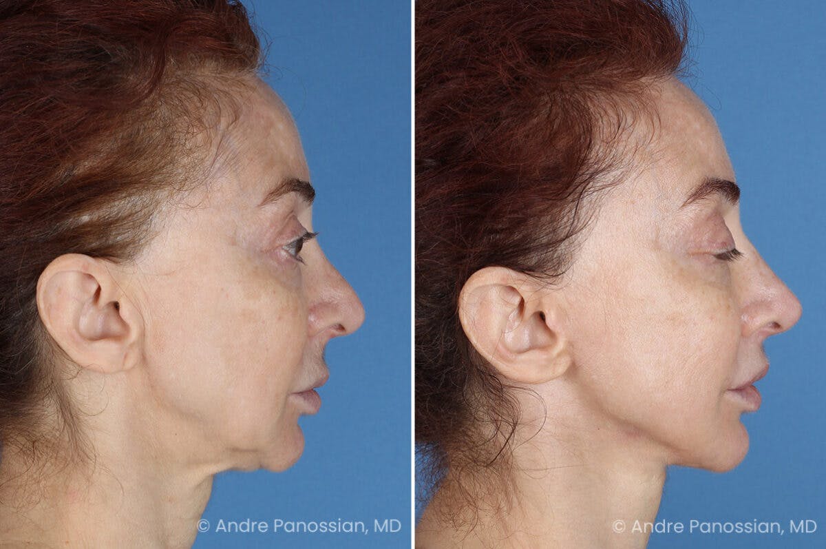 Facelift & Neck Lift Before & After Gallery - Patient 188334 - Image 3