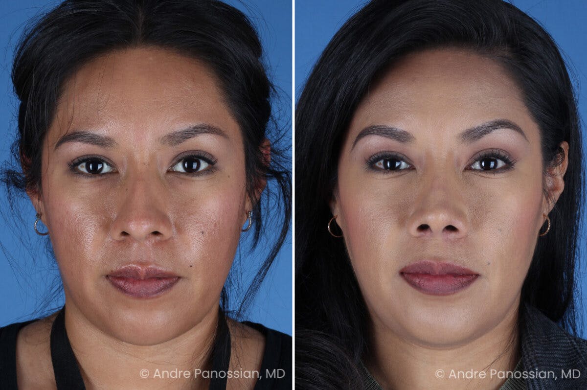 Rhinoplasty Before & After Gallery - Patient 337566 - Image 2