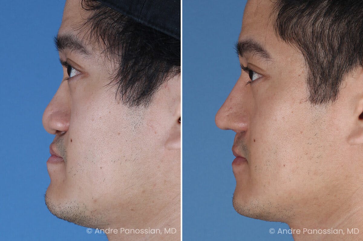 Cleft Lip Rhinoplasty Before & After Gallery - Patient 266817 - Image 5