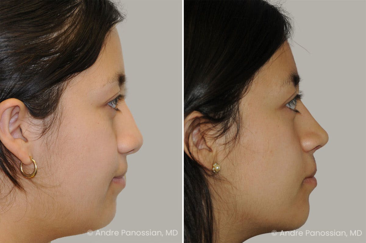 Revision Rhinoplasty Before & After Gallery - Patient 440261 - Image 1