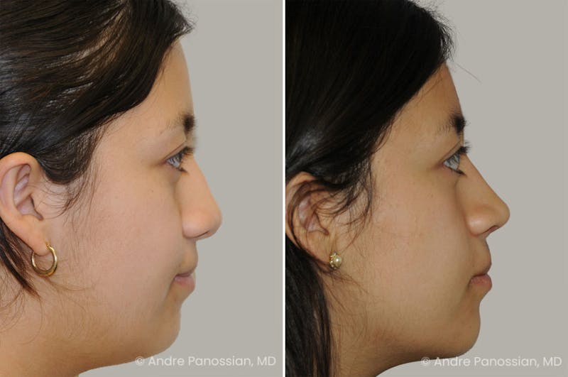 Revision Rhinoplasty Before & After Gallery - Patient 440261 - Image 1