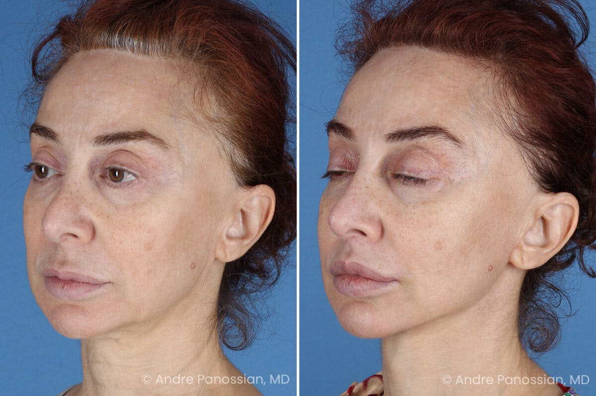 Facelift & Neck Lift Before & After Gallery - Patient 188334 - Image 4
