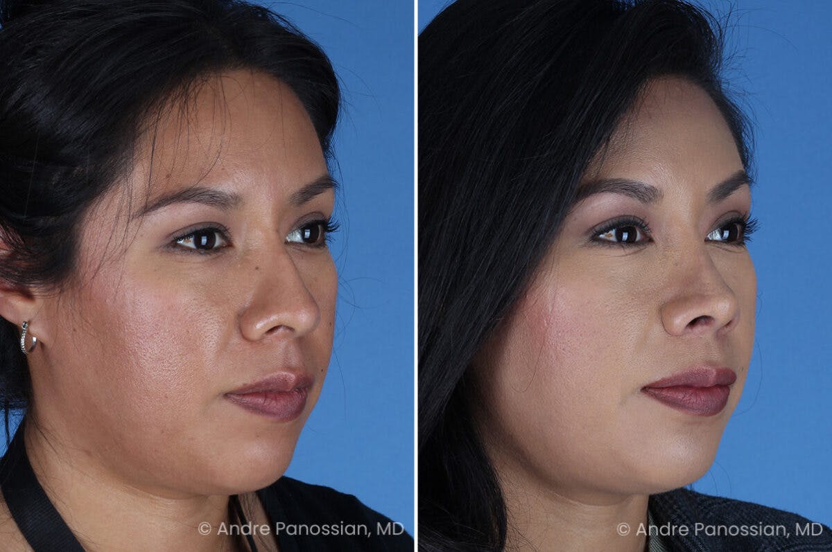 Rhinoplasty Before & After Gallery - Patient 337566 - Image 3