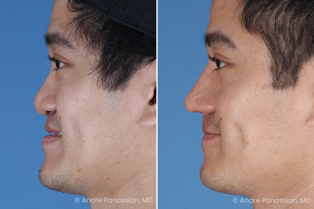Cleft Lip Rhinoplasty Before & After Gallery - Patient 266817 - Image 6