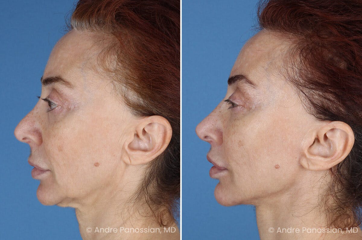 Facelift & Neck Lift Before & After Gallery - Patient 188334 - Image 5
