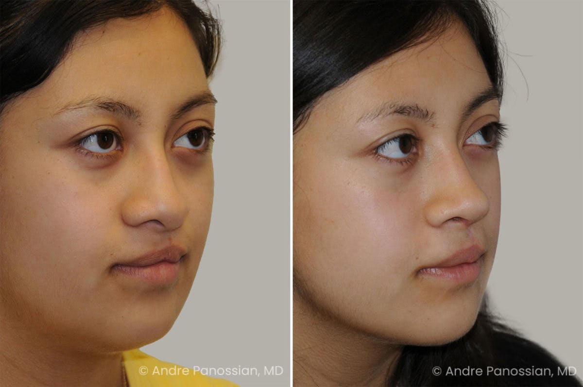 Revision Rhinoplasty Before & After Gallery - Patient 440261 - Image 3