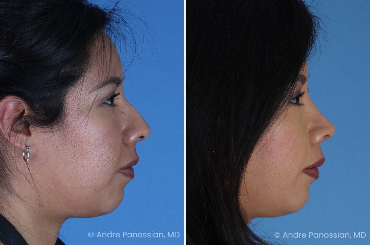 Rhinoplasty Before & After Gallery - Patient 337566 - Image 1