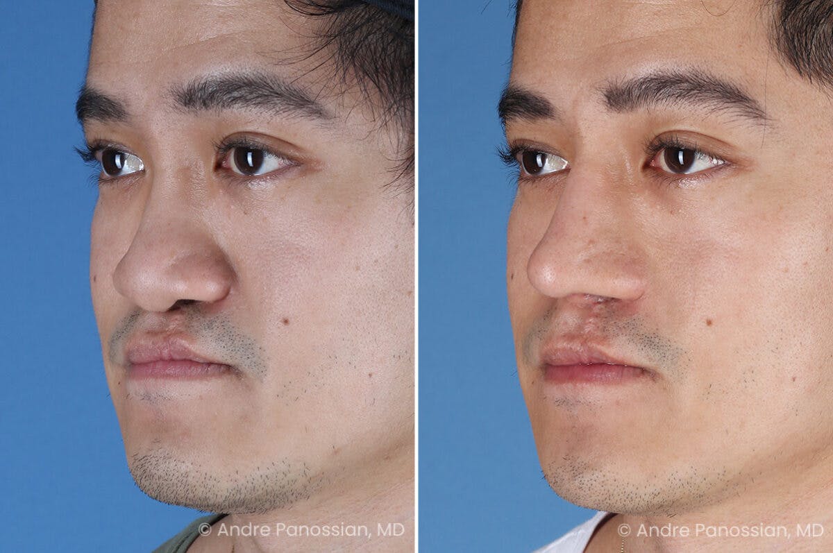 Cleft Lip Rhinoplasty Before & After Gallery - Patient 266817 - Image 7