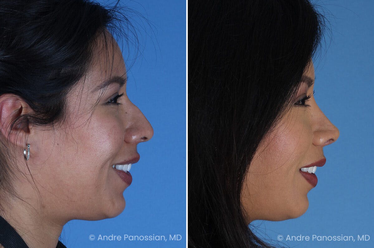 Rhinoplasty Before & After Gallery - Patient 337566 - Image 4