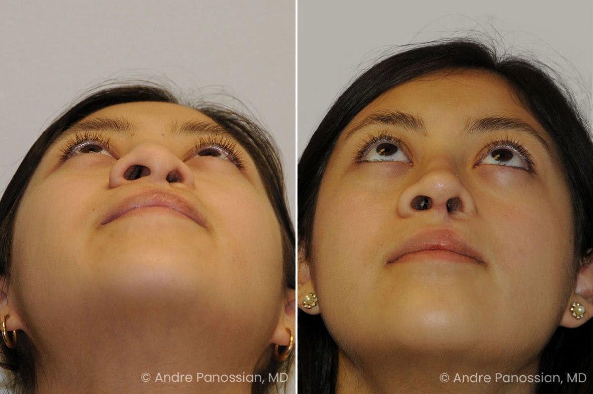 Revision Rhinoplasty Before & After Gallery - Patient 440261 - Image 4