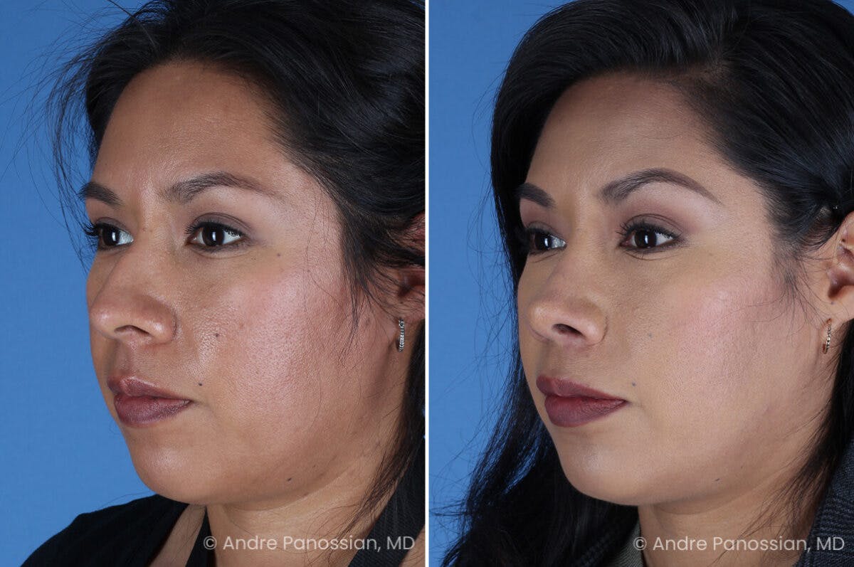 Rhinoplasty Before & After Gallery - Patient 337566 - Image 5