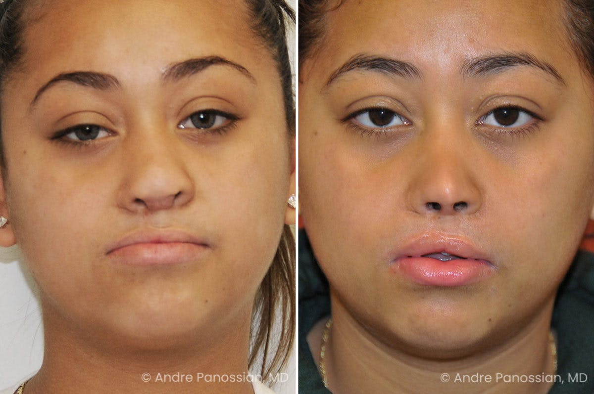 Revision Rhinoplasty Before & After Gallery - Patient 160548 - Image 2