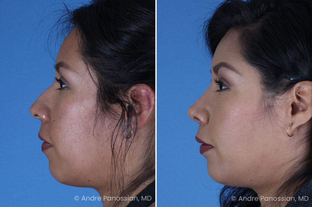 Rhinoplasty Before & After Gallery - Patient 337566 - Image 6