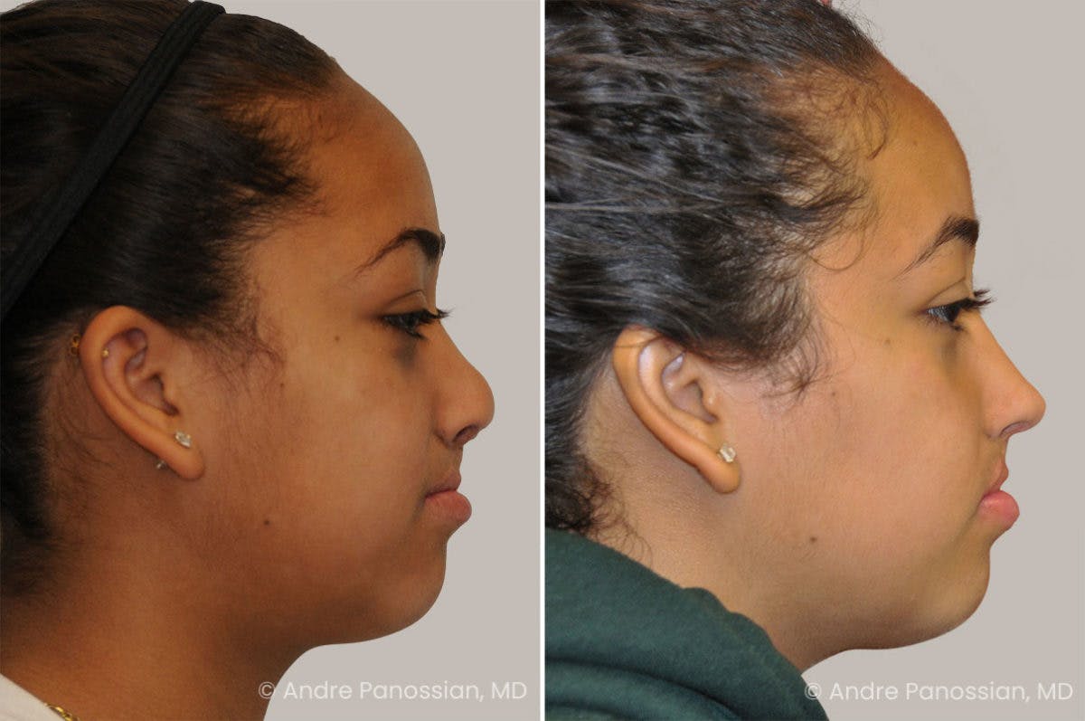 Revision Rhinoplasty Before & After Gallery - Patient 160548 - Image 1