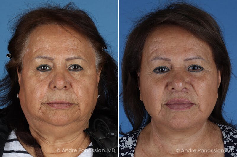 Facelift & Neck Lift Before & After Gallery - Patient 203637 - Image 1
