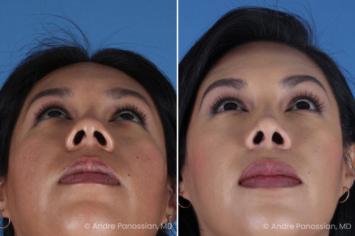 Rhinoplasty Before & After Gallery - Patient 337566 - Image 7