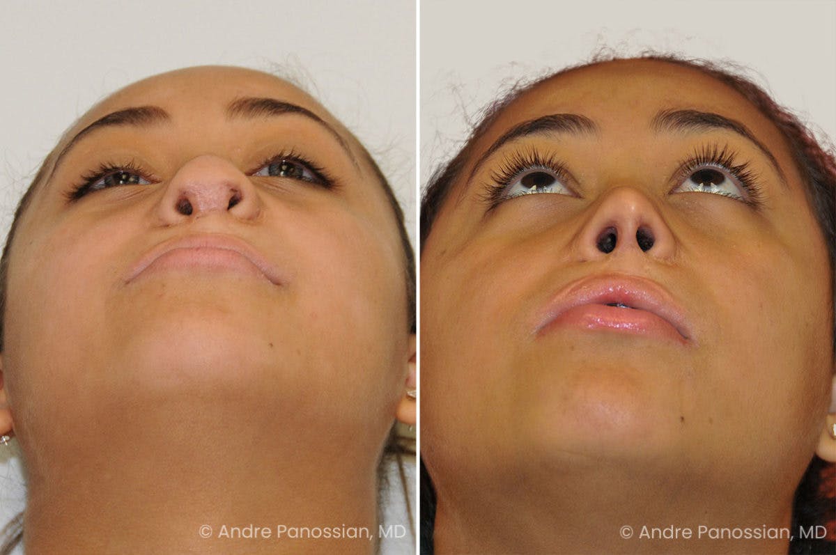 Revision Rhinoplasty Before & After Gallery - Patient 160548 - Image 3