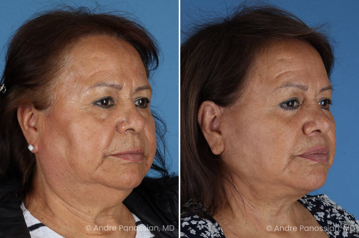 Facelift & Neck Lift Before & After Gallery - Patient 203637 - Image 2