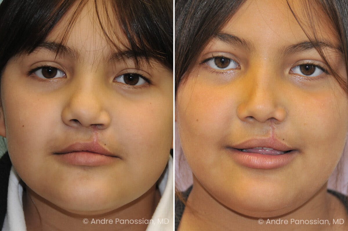 Cleft Lip Rhinoplasty Before & After Gallery - Patient 193854 - Image 2