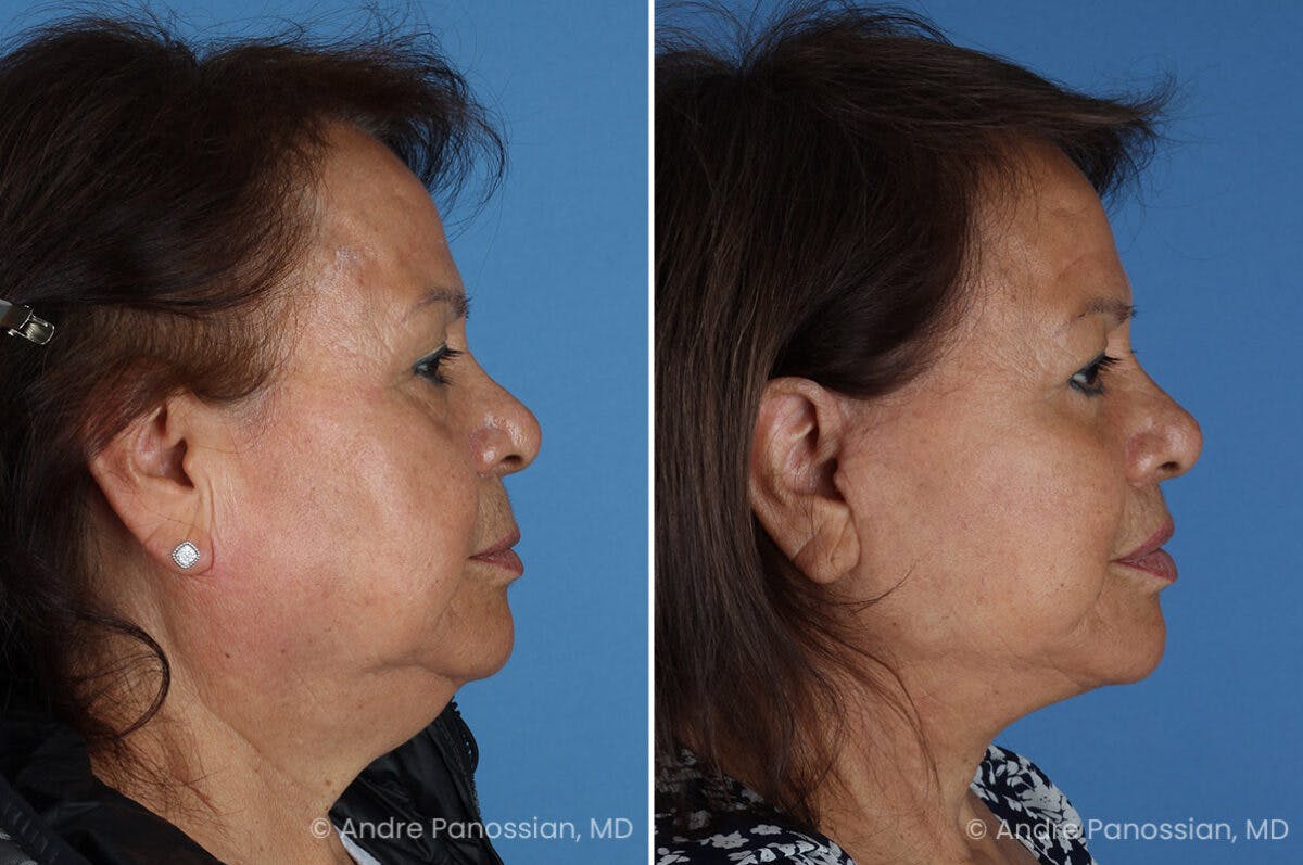 Facelift & Neck Lift Before & After Gallery - Patient 203637 - Image 3
