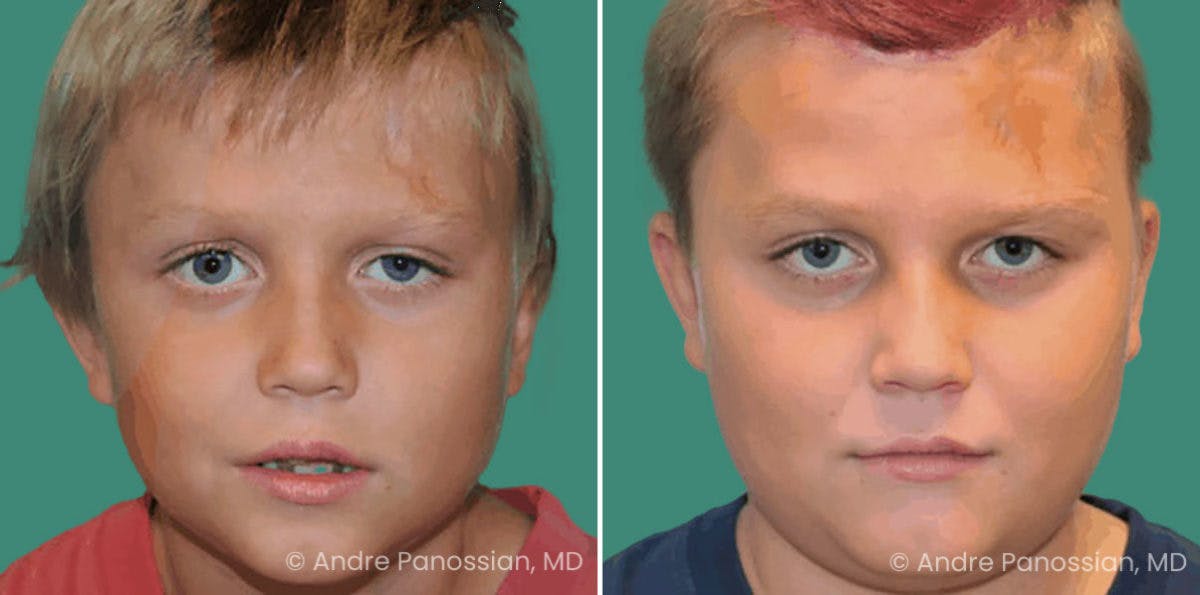 Brow Lift Before & After Gallery - Patient 688534 - Image 1