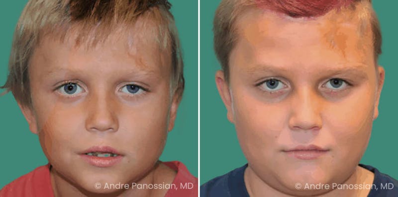 Brow Lift Before & After Gallery - Patient 688534 - Image 1