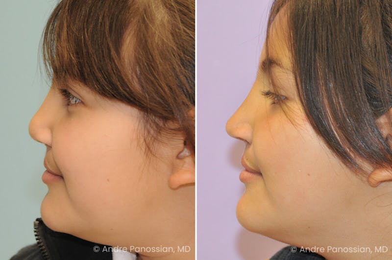 Cleft Lip Rhinoplasty Before & After Gallery - Patient 193854 - Image 1