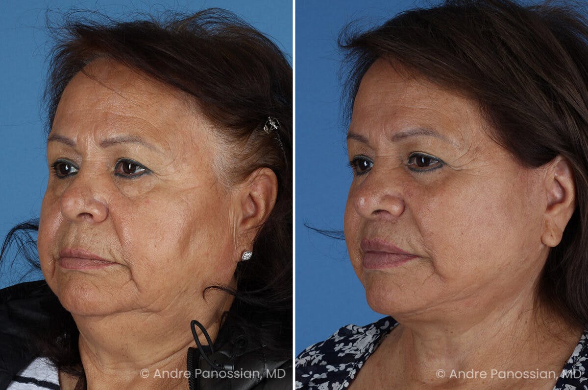 Facelift & Neck Lift Before & After Gallery - Patient 203637 - Image 4