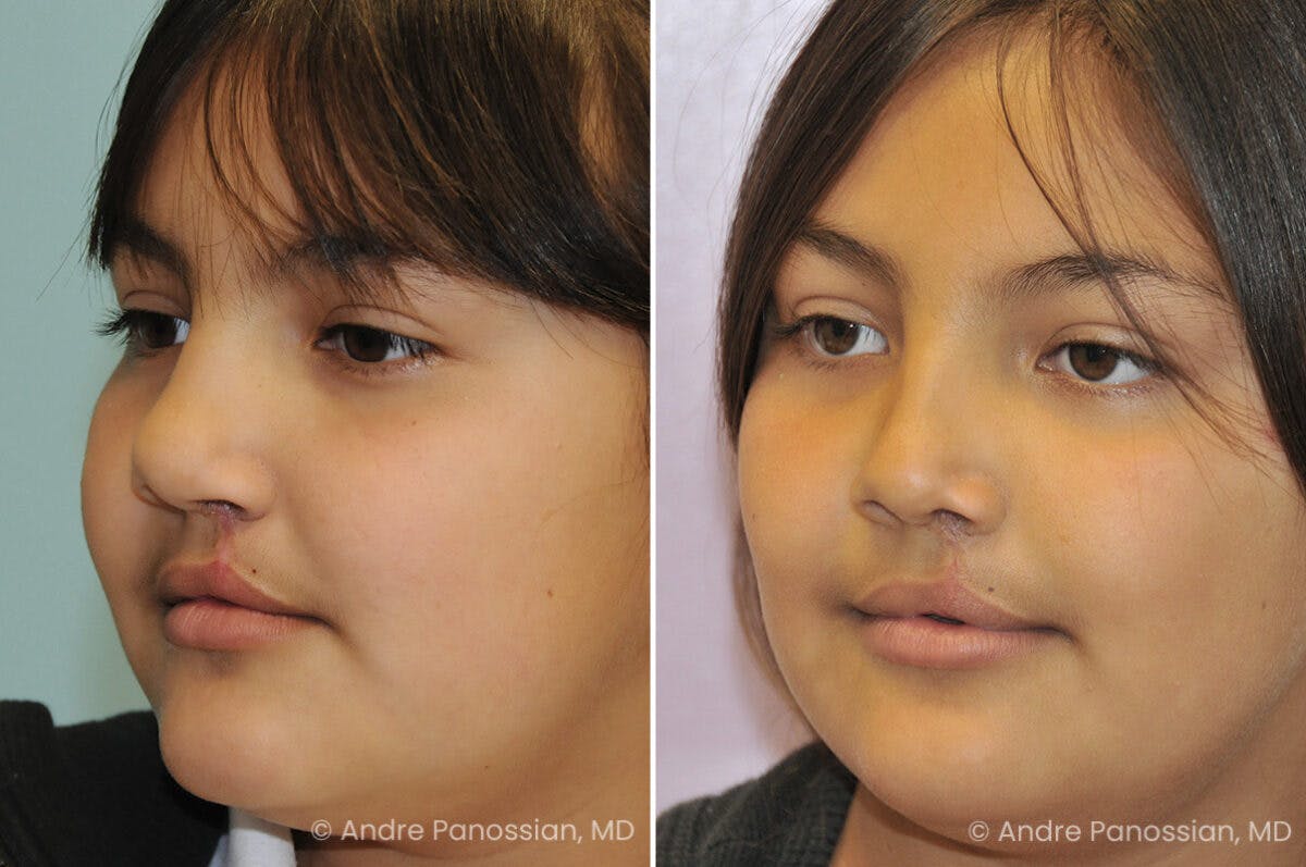 Cleft Lip Rhinoplasty Before & After Gallery - Patient 193854 - Image 3