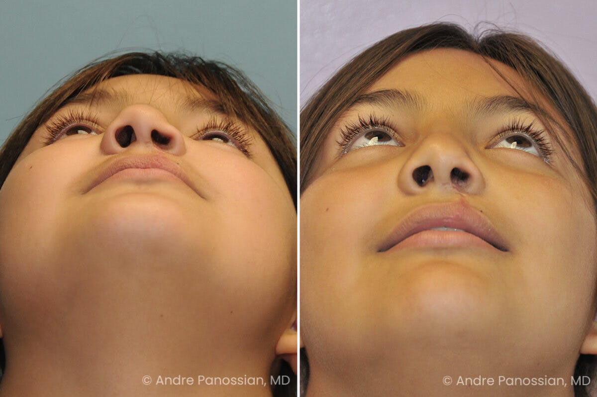 Cleft Lip Rhinoplasty Before & After Gallery - Patient 193854 - Image 4