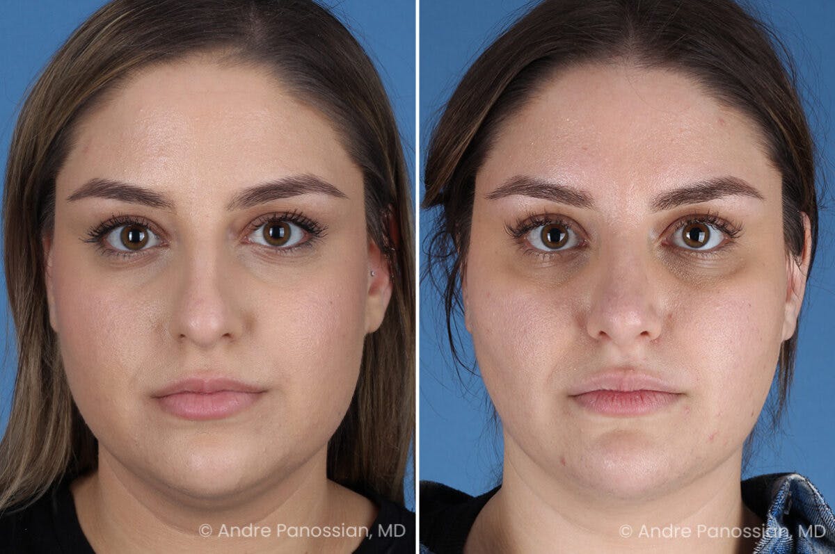 Rhinoplasty Before & After Gallery - Patient 153862 - Image 2