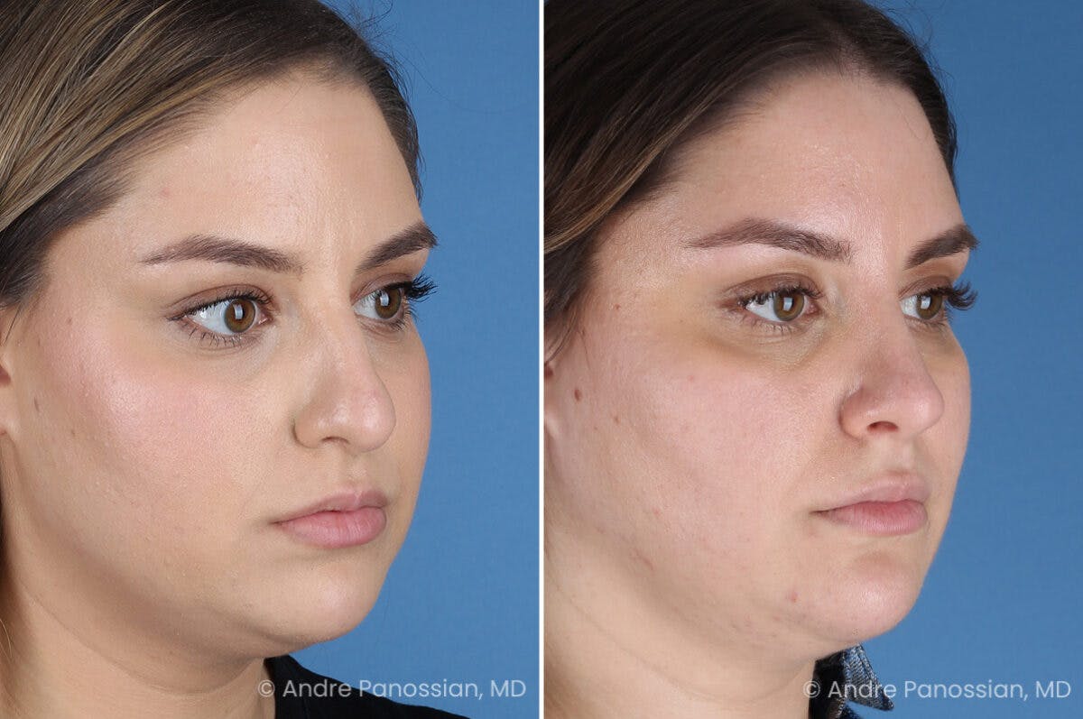 Rhinoplasty Before & After Gallery - Patient 153862 - Image 3