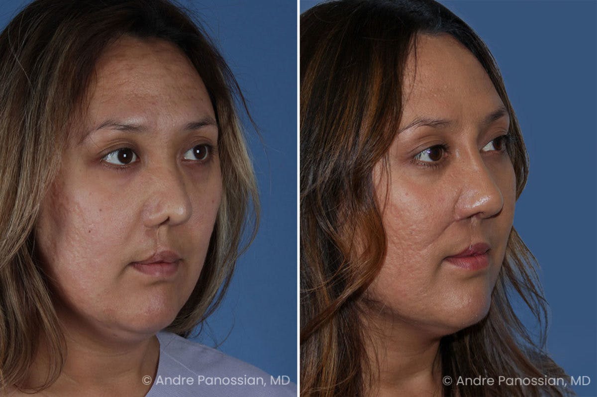 Revision Rhinoplasty Before & After Gallery - Patient 411455 - Image 3