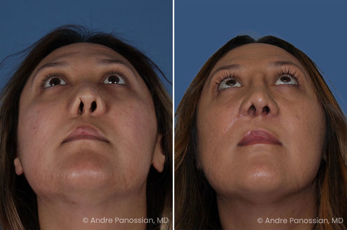 Revision Rhinoplasty Before & After Gallery - Patient 411455 - Image 4
