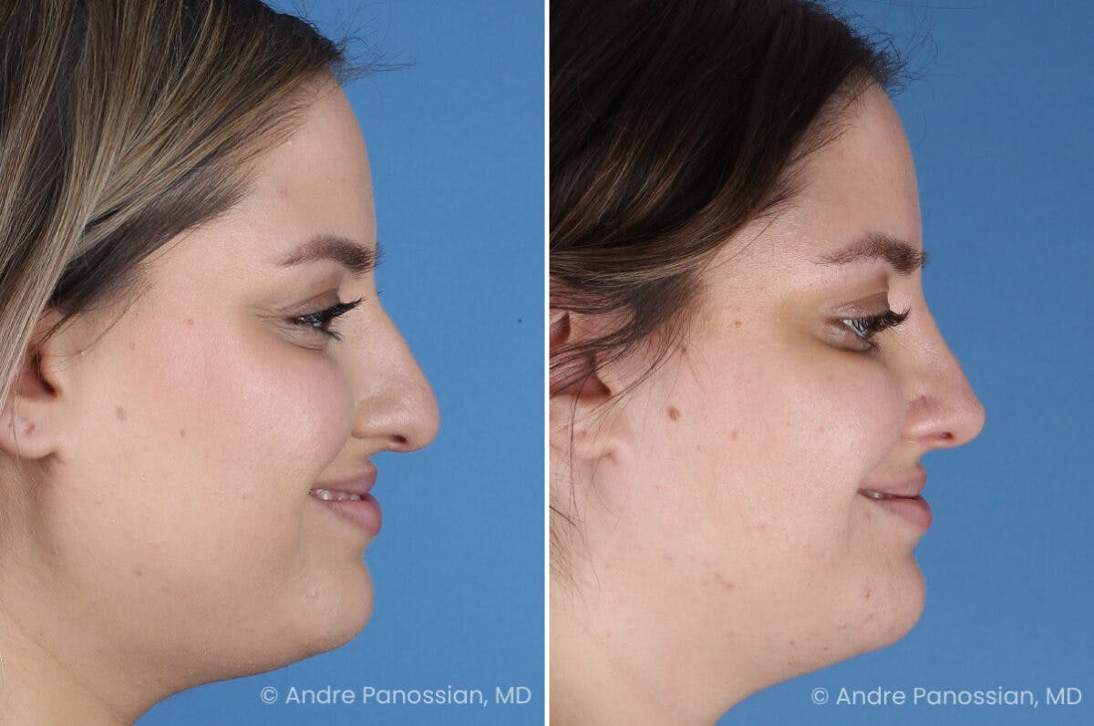 Rhinoplasty Before & After Gallery - Patient 153862 - Image 1