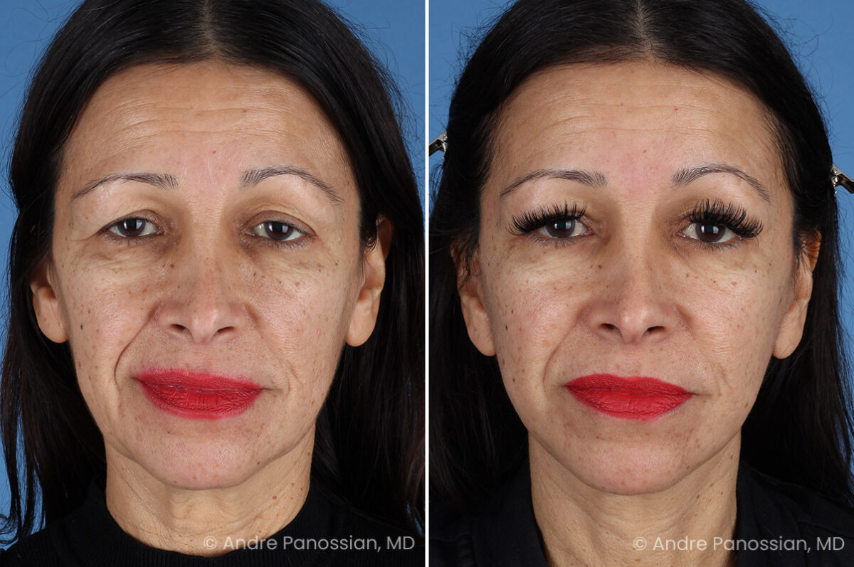 Facelift & Neck Lift Before & After Photos | Andre Panossian, M.D.