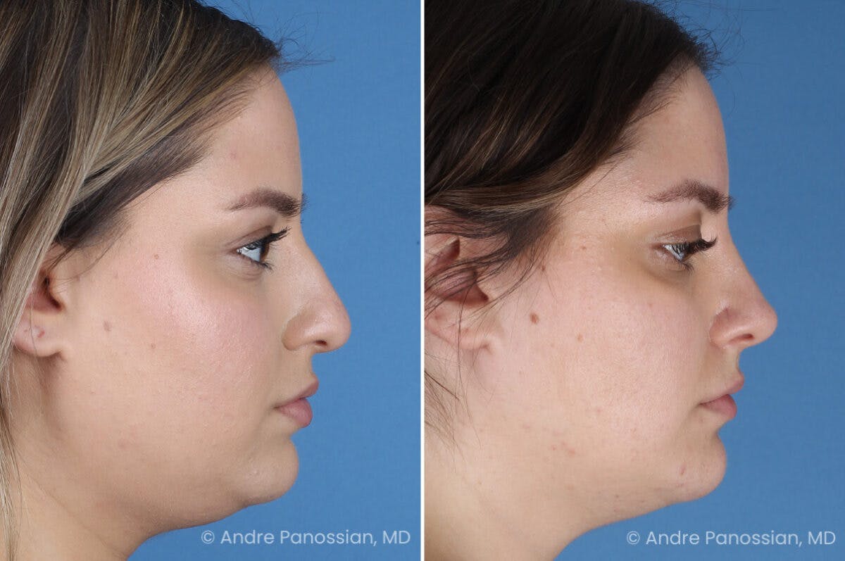 Rhinoplasty Before & After Gallery - Patient 153862 - Image 4