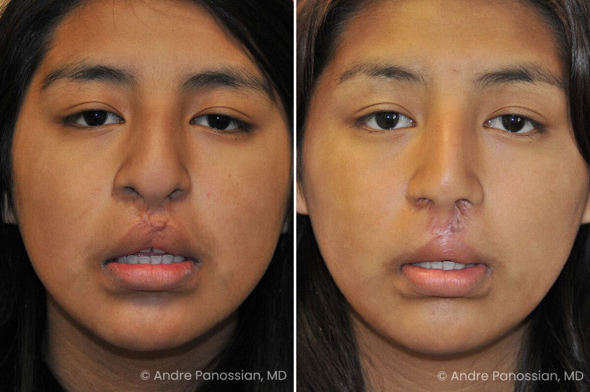 Cleft Lip Rhinoplasty Before & After Gallery - Patient 355708 - Image 2