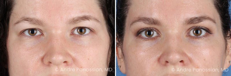 Eyelid Surgery (Blepharoplasty) Before & After Gallery - Patient 182379 - Image 1