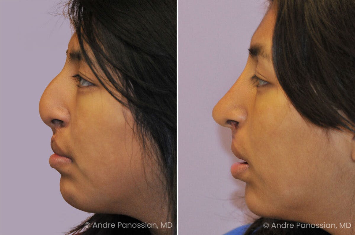 Cleft Lip Rhinoplasty Before & After Gallery - Patient 355708 - Image 1