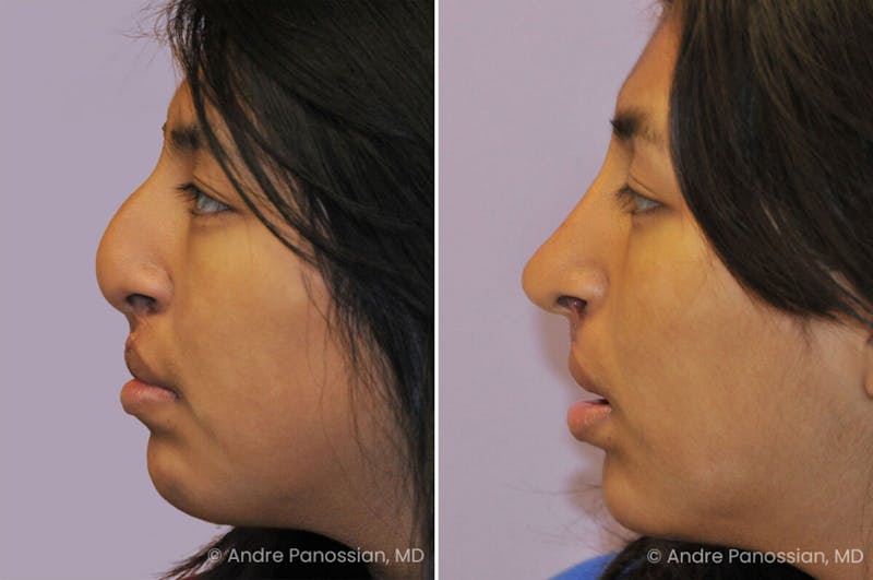Cleft Lip Rhinoplasty Before & After Gallery - Patient 355708 - Image 1