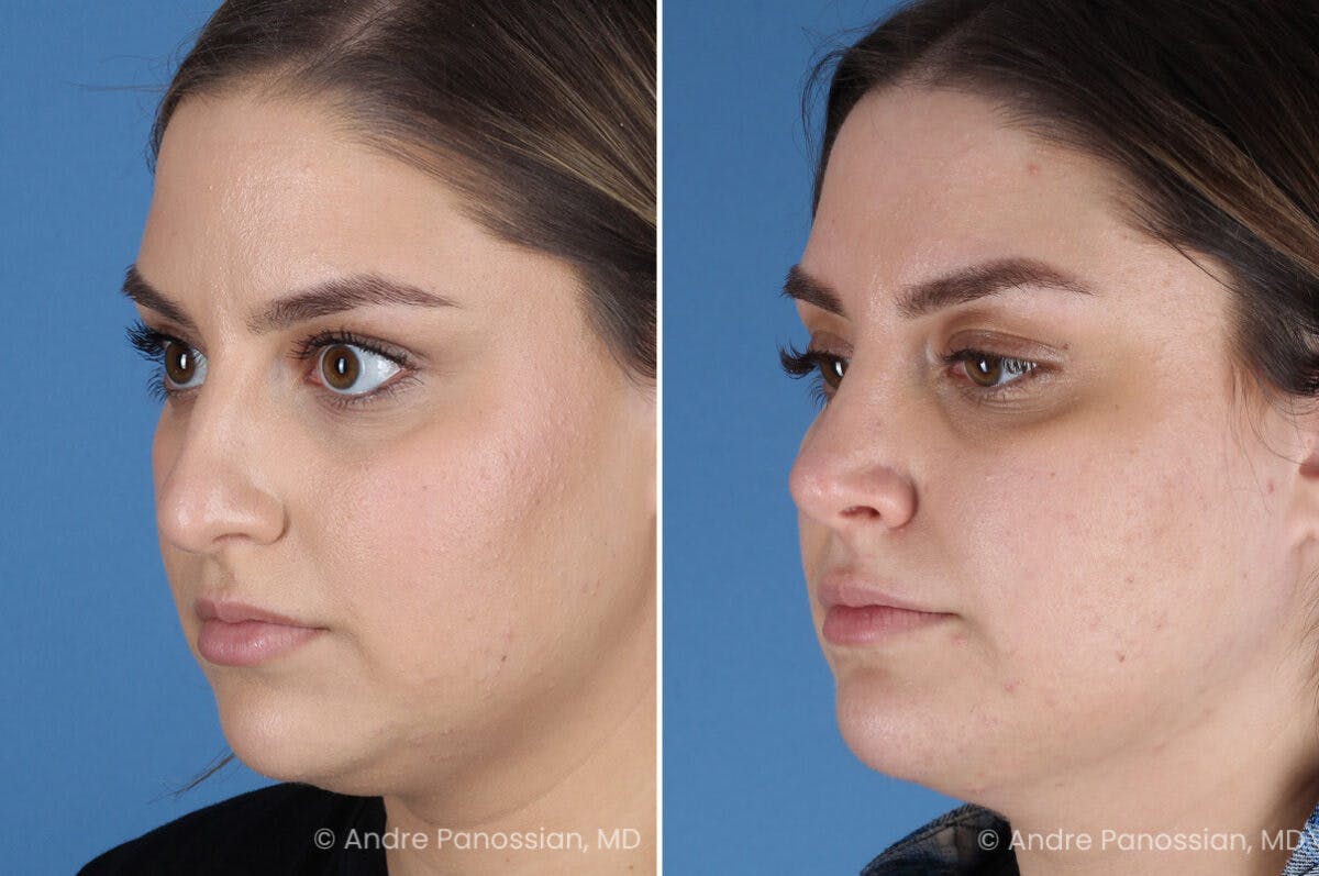 Rhinoplasty Before & After Gallery - Patient 153862 - Image 5
