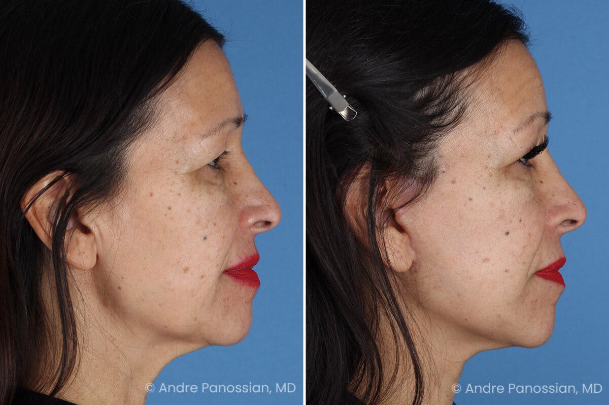Facelift & Neck Lift Before & After Gallery - Patient 259086 - Image 3